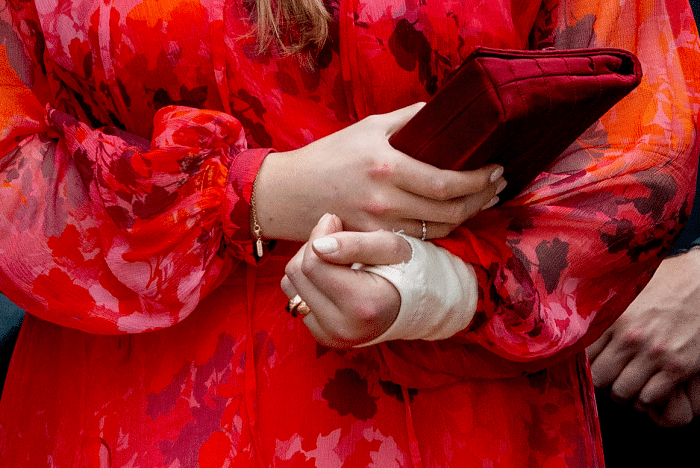 Amalia breekt arm gips